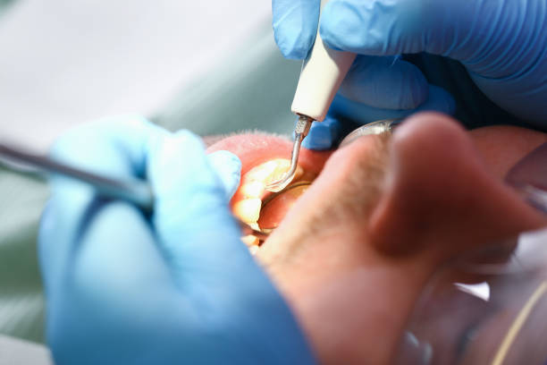 Best Emergency Dentist for Lost Fillings or Crowns in Stockton, MO